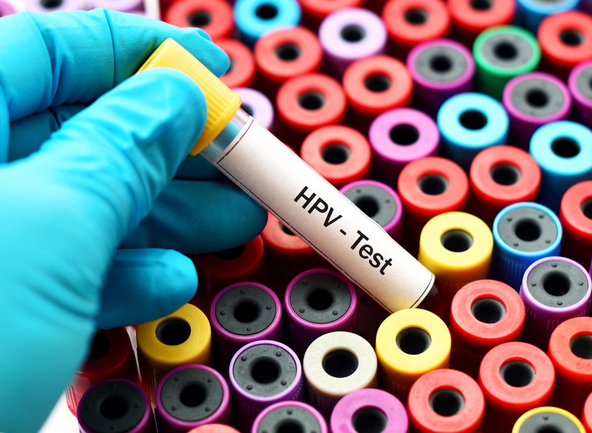 Cancer du col de l'utérus : des médecins et des patients militent pour privilégier le test HPV 