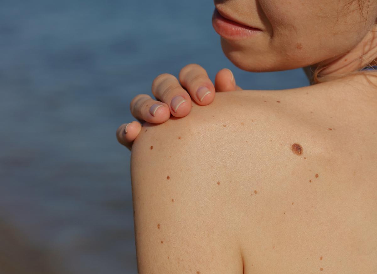 Cancer de la peau : comment reconnaître un grain de beauté suspect?