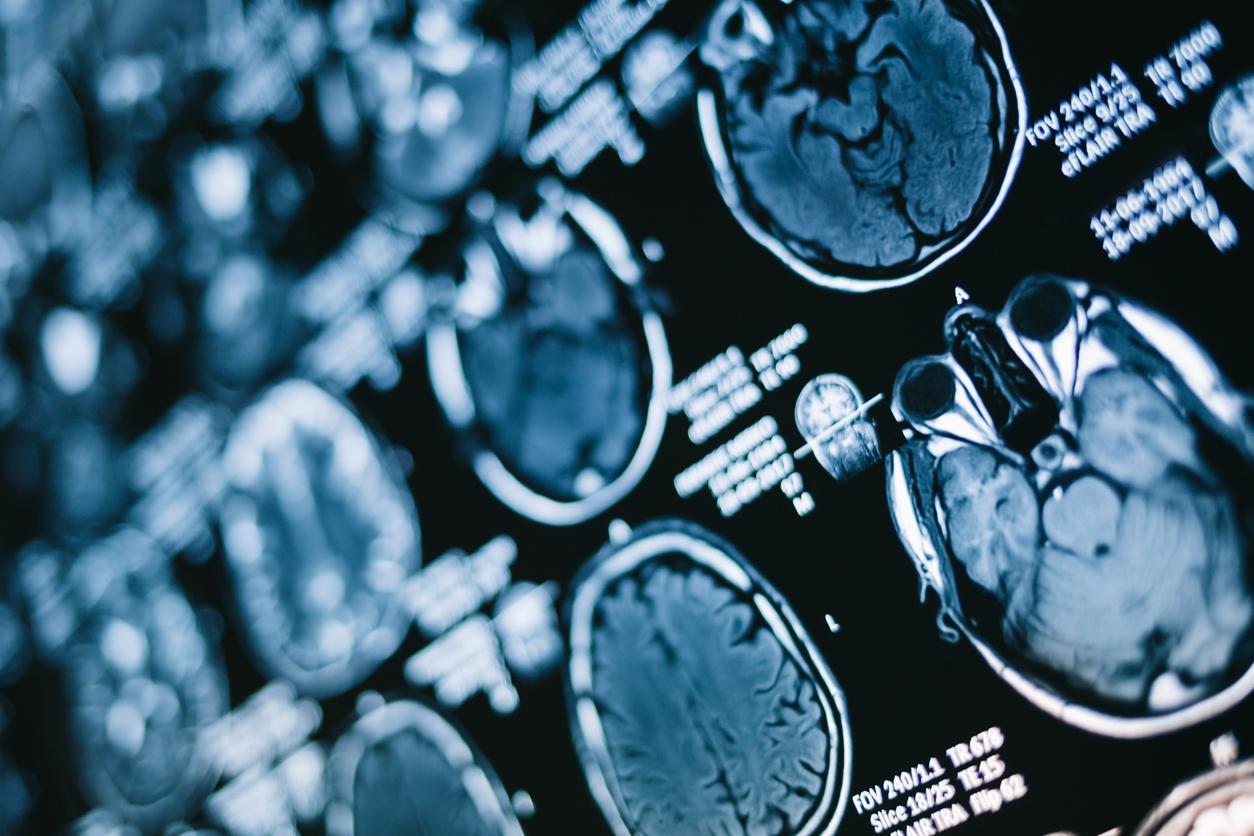 Alzheimer : on en sait plus sur la dégradation de la communication entre les cellules cérébrales