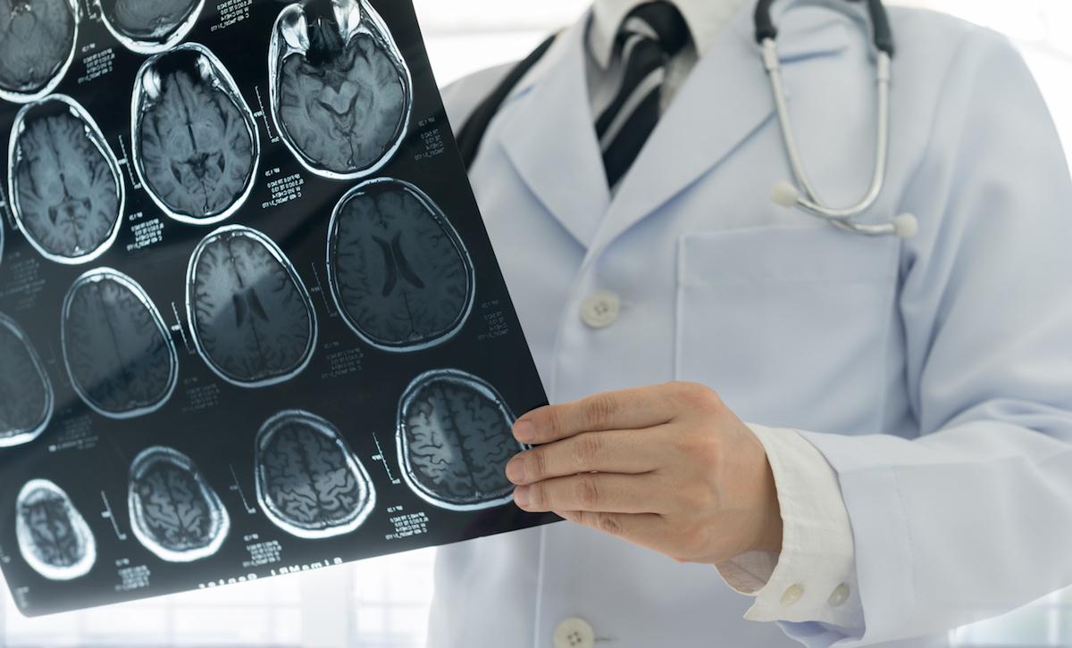 Androcur : 112 000 courriers envoyés pour alerter les patients du risque de tumeur cérébrale