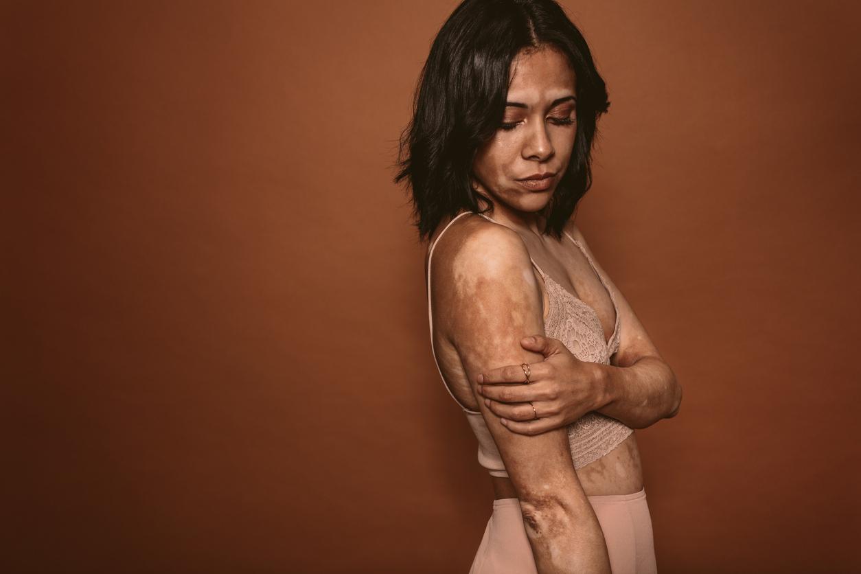 Vitiligo : un premier traitement pour re-pigmenter la peau autorisé en Europe 