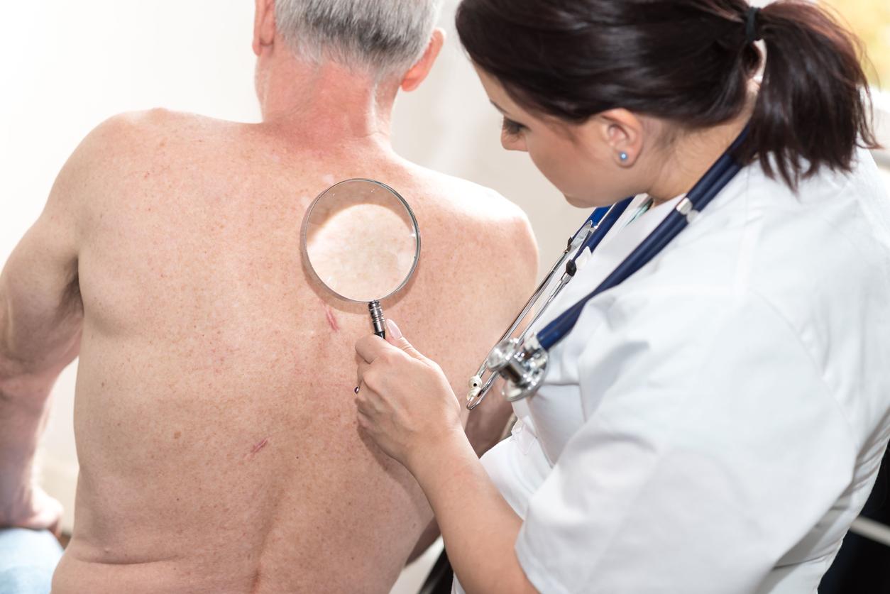 Un traitement réduirait de 75% les risques de cancer de la peau