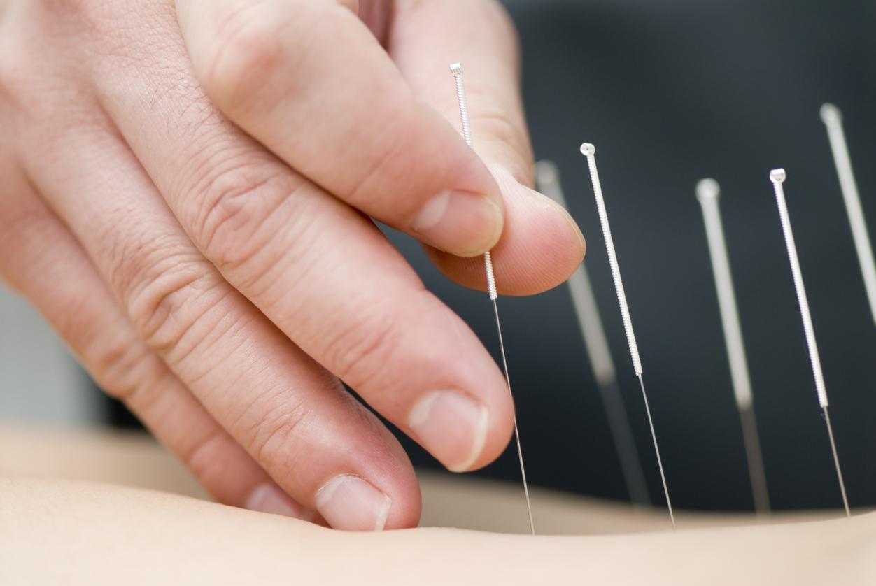L'acupuncture peut soulager certaines douleurs des femmes enceintes