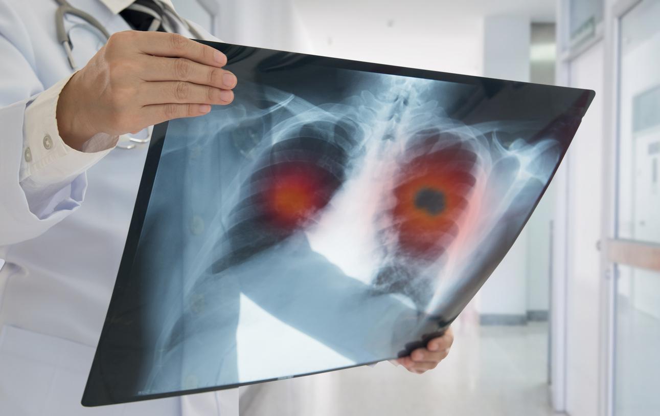 Cancer du poumon : les vitamines boostent la croissance des tumeurs