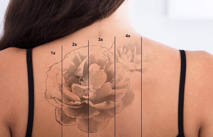 Se « détatouer », le vrai problème du tatouage