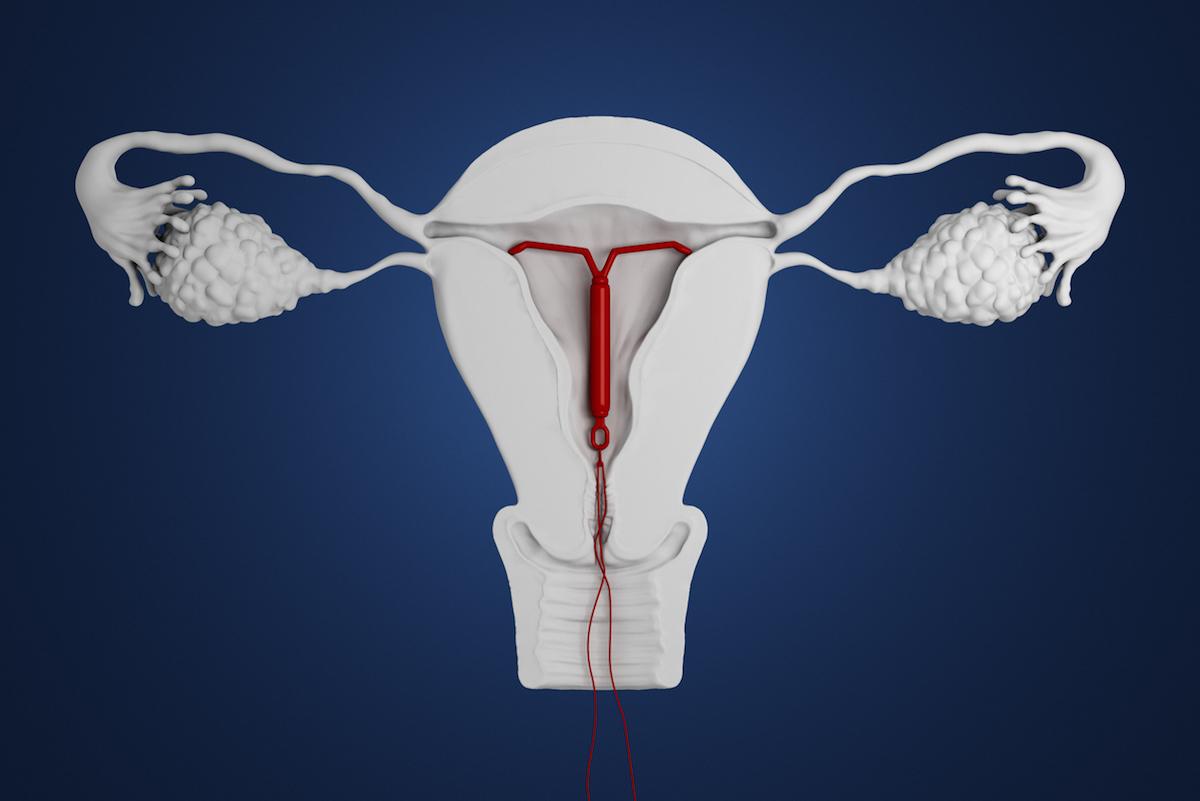 Contraception : Donald Trump influence fortement le choix des femmes