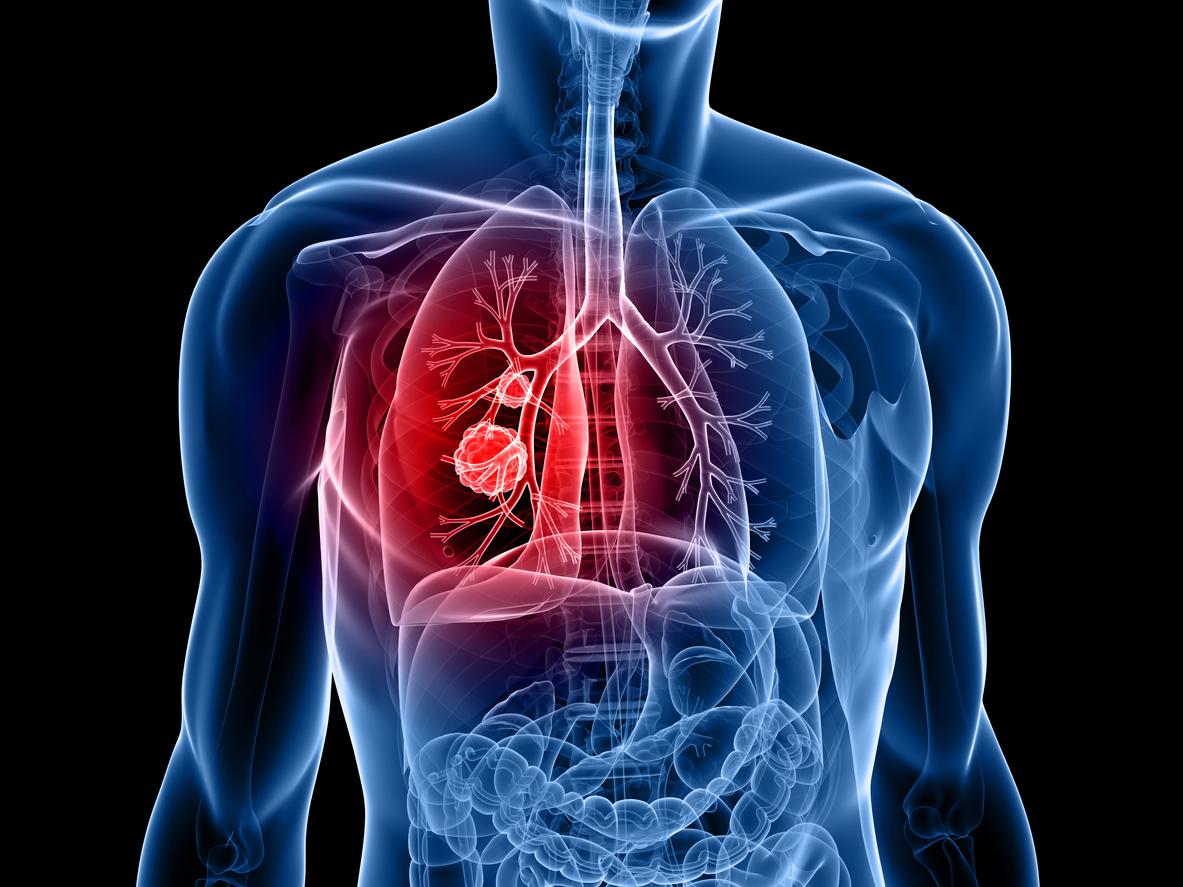 Tumeur du poumon : une technique d’ablation non-chirurgicale utilisée en France