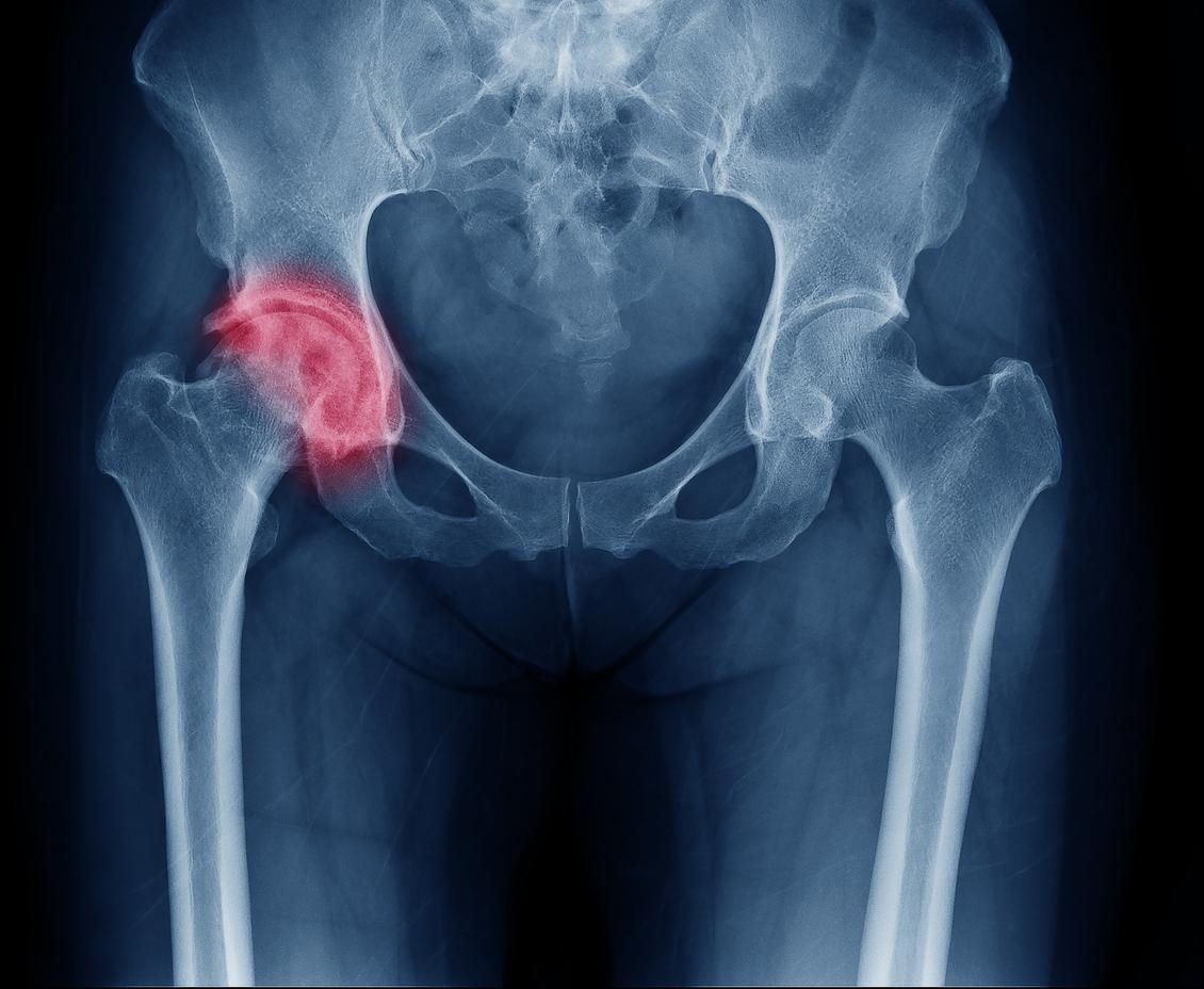Les femmes végétariennes ont plus de risques de se fracturer la hanche