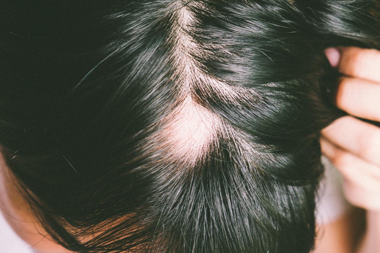 Un médicament courant pourrait-il aider à faire repousser les cheveux ?