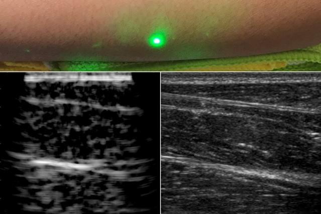 La première échographie laser réalisée à distance grâce aux ultrasons