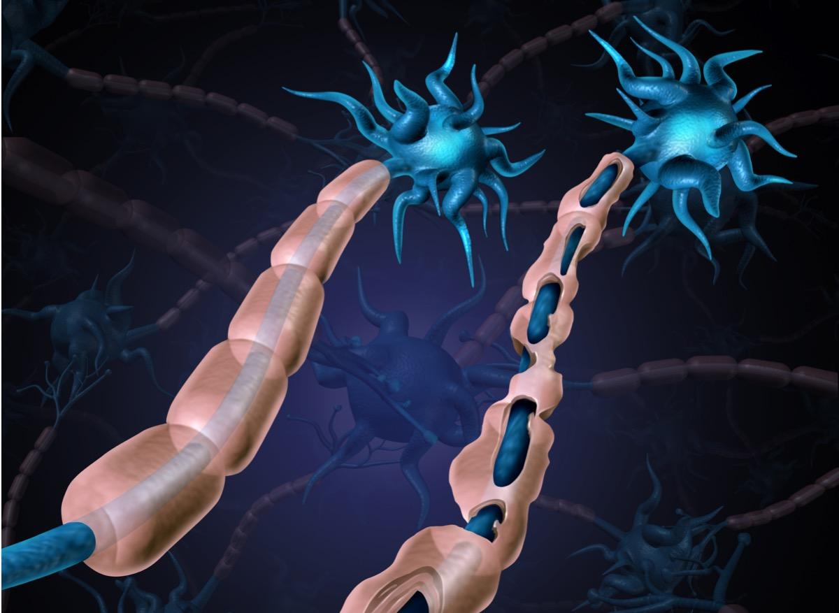 Sclérose en plaques : qu’est-ce que le traitement par cellules souches ?