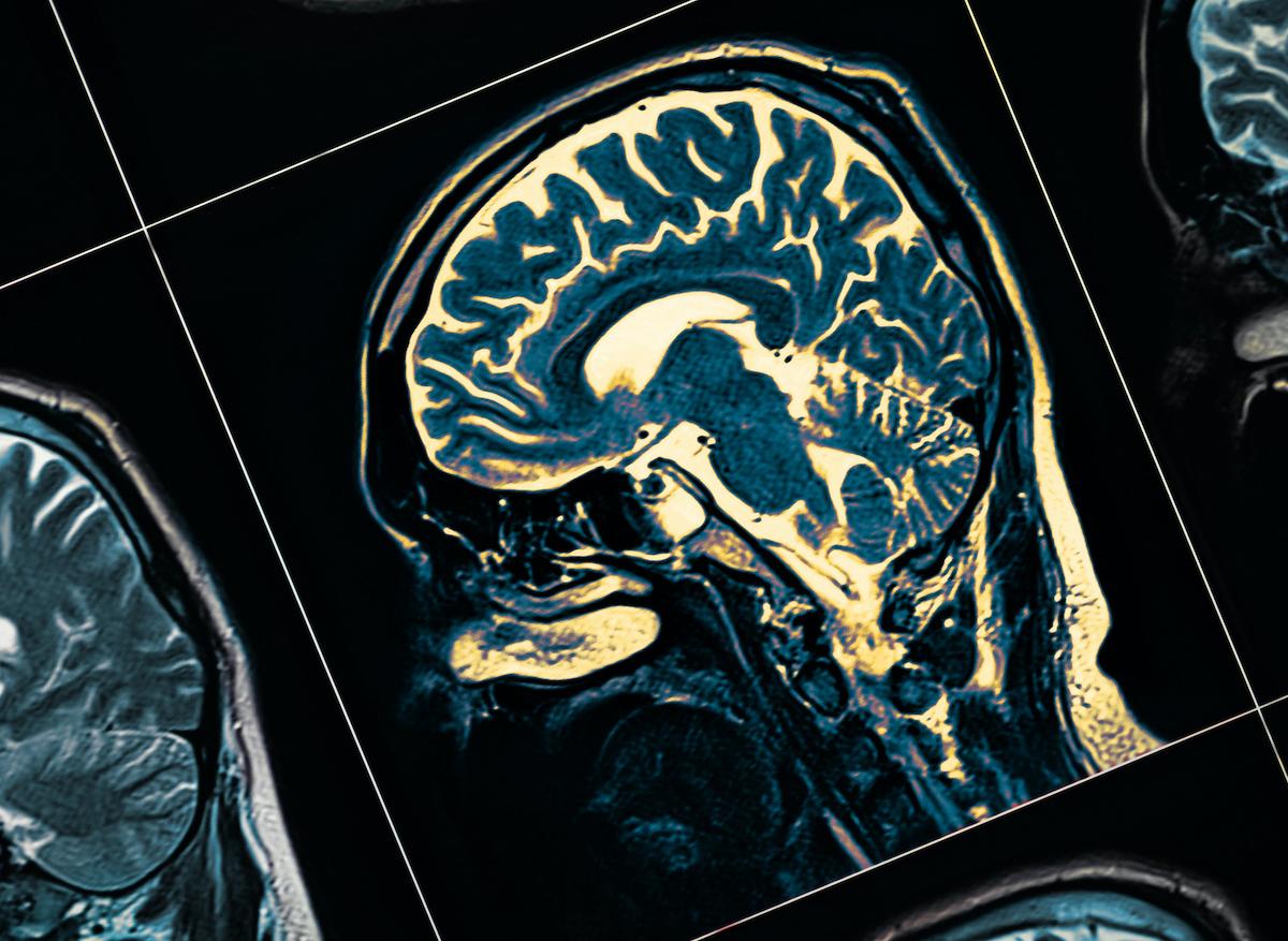 Une étude suggère un lien entre le trouble bipolaire et la maladie de Parkinson