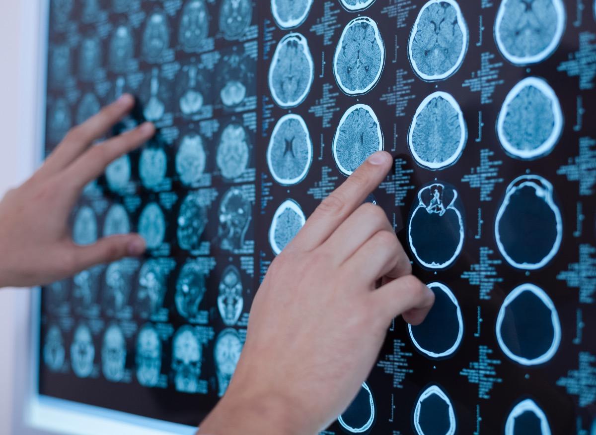 Utiliser l’IRM pour prédire le risque de suicide 