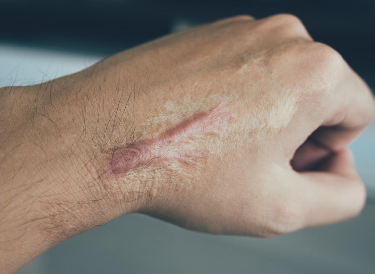 Comment éviter les cicatrices trop visibles ? 