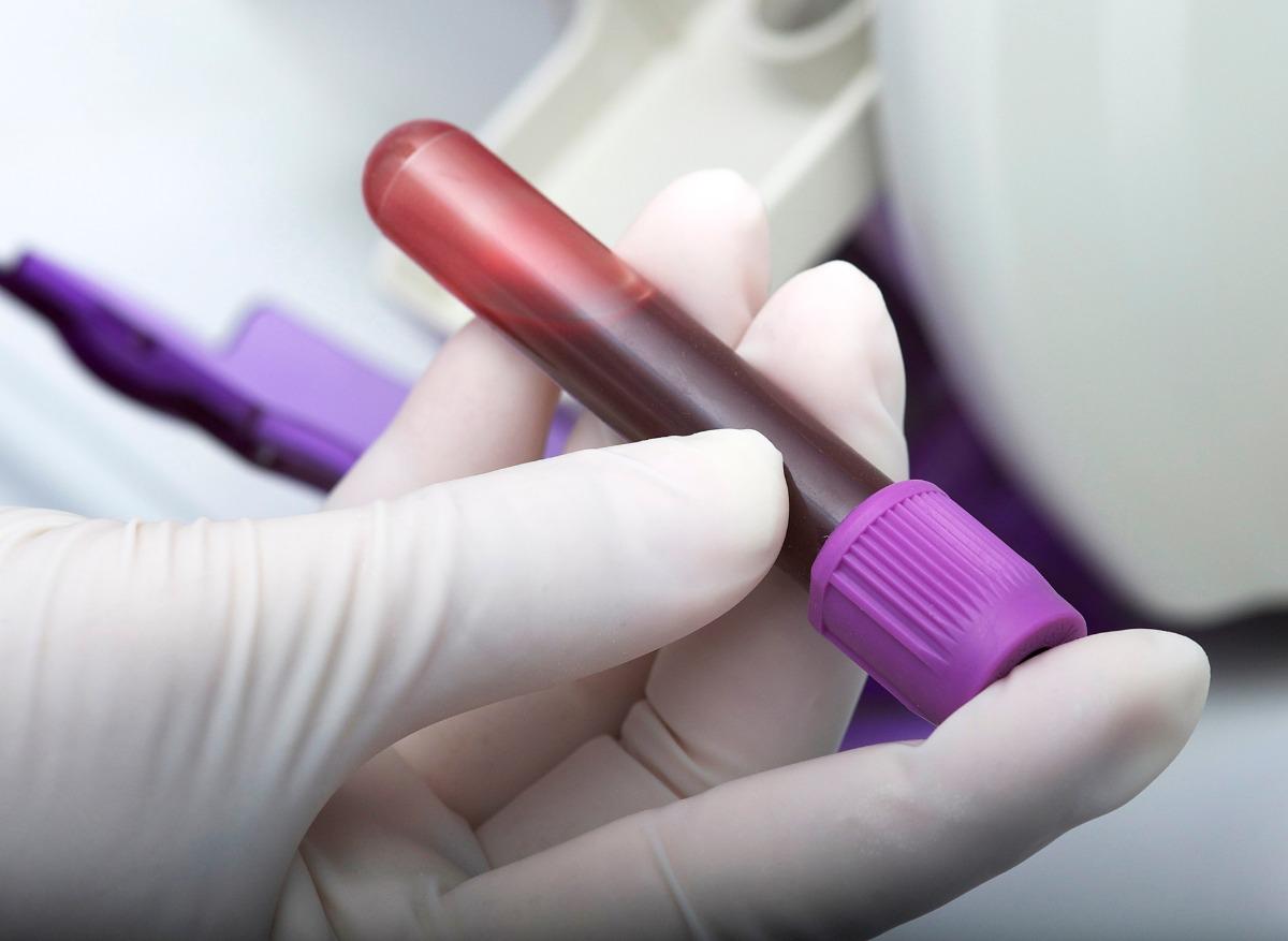Crise cardiaque : des chercheurs invitent à se méfier des tests sanguins qui servent au diagnostic