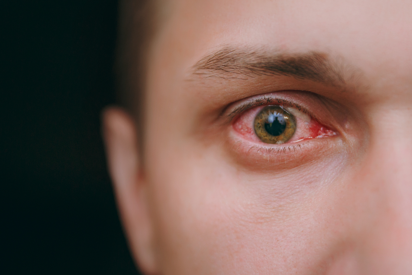 L'examen des cils peut révéler des maladies oculaires