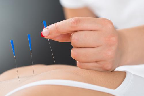 Migraine : l'acupuncture réduit la fréquence des crises 
