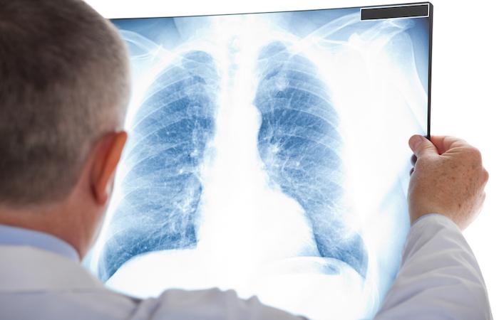 Cancer du poumon : 15 mois de rémission grâce à une thérapie ciblée