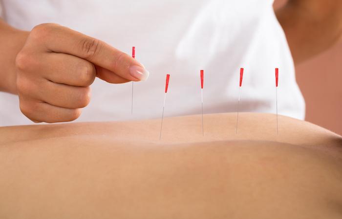 Cancer du sein : des séances d'acupuncture pour soulager les douleurs articulaires ? 