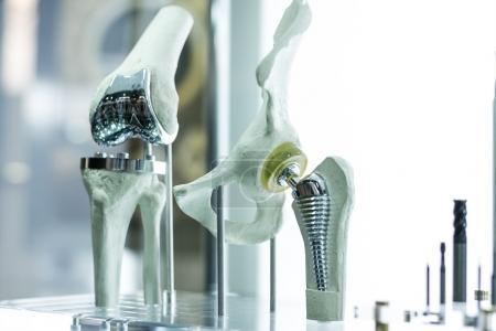 La prothèse du genou connectée : une première mondiale