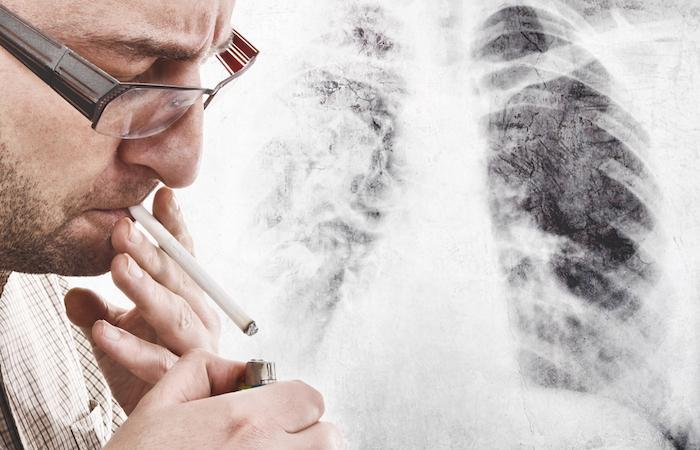 Cancer du poumon non opérable : les vrais espoirs de l’immunothérapie