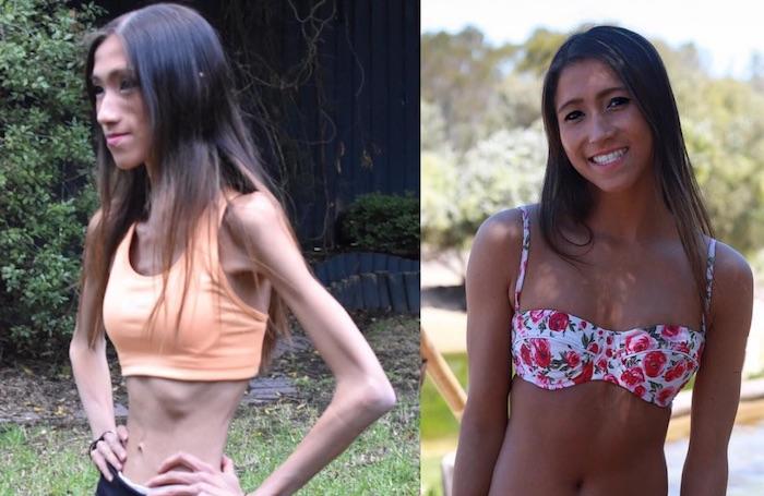 Après son anorexie, elle partage les photos de sa guérison