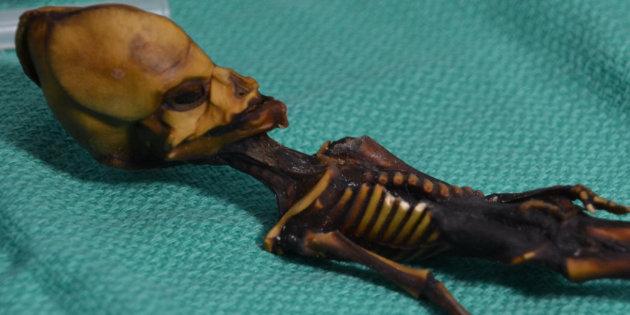 Le squelette  extraterrestre d’Atacama? Une petite fille au corps déformé par une maladie génétique...