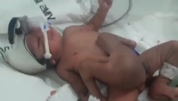 Inde : un bébé naît avec 4 jambes