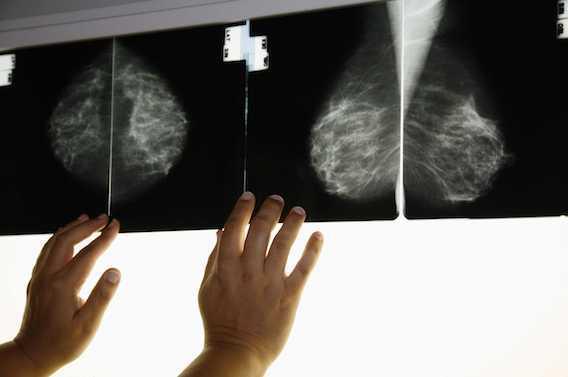 Cancer du sein :  22 séances de rayons réalisées du mauvais côté