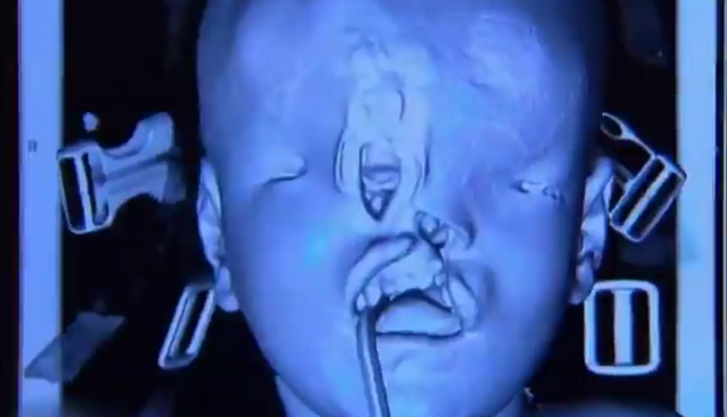L'enfant né sans visage a été opéré avec succès