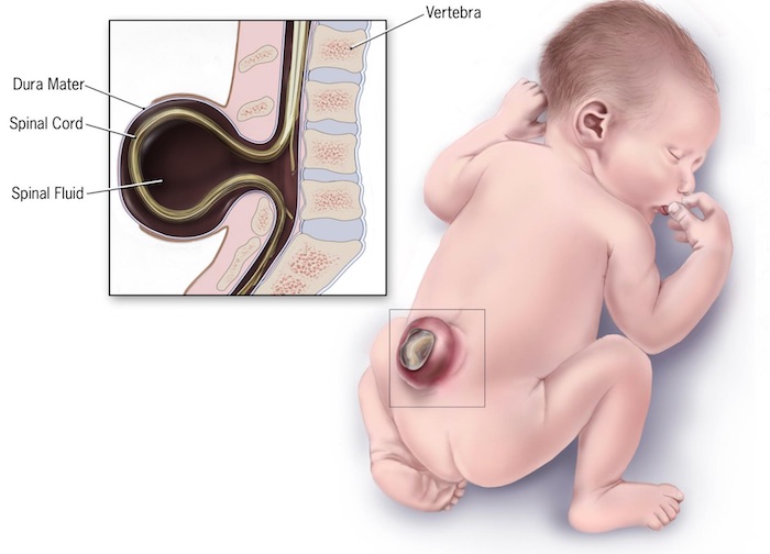 Spina bifida : deux bébés opérés dans l’utérus, un exploit médical