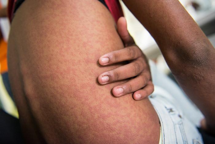 Chikungunya : 11 cas confirmés dans le Var