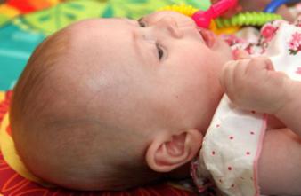 Crâne plat des bébés : le port d'un casque serait inefficace 