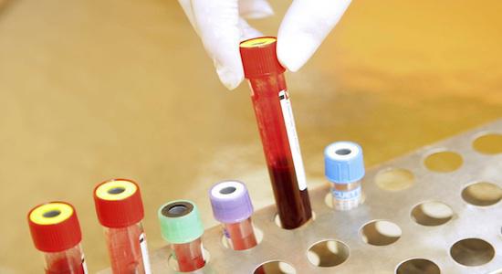 Trisomie 21: les gynécos favorables au test de dépistage sanguin