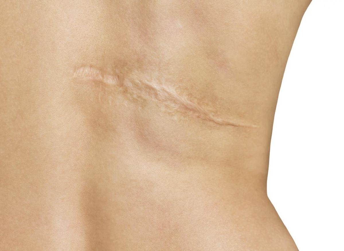 Comment éviter qu'une cicatrice ne devienne “hypertrophique”?