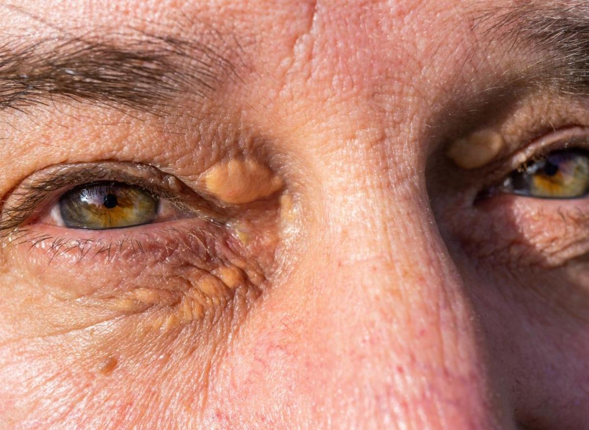 Cholestérol : vous pouvez repérer dans vos yeux certains symptômes