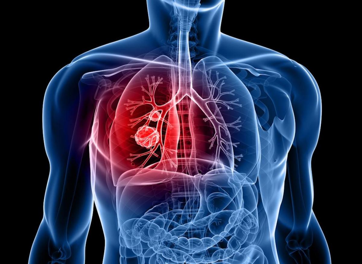 Cancer du poumon : l'intelligence artificielle améliore le dépistage