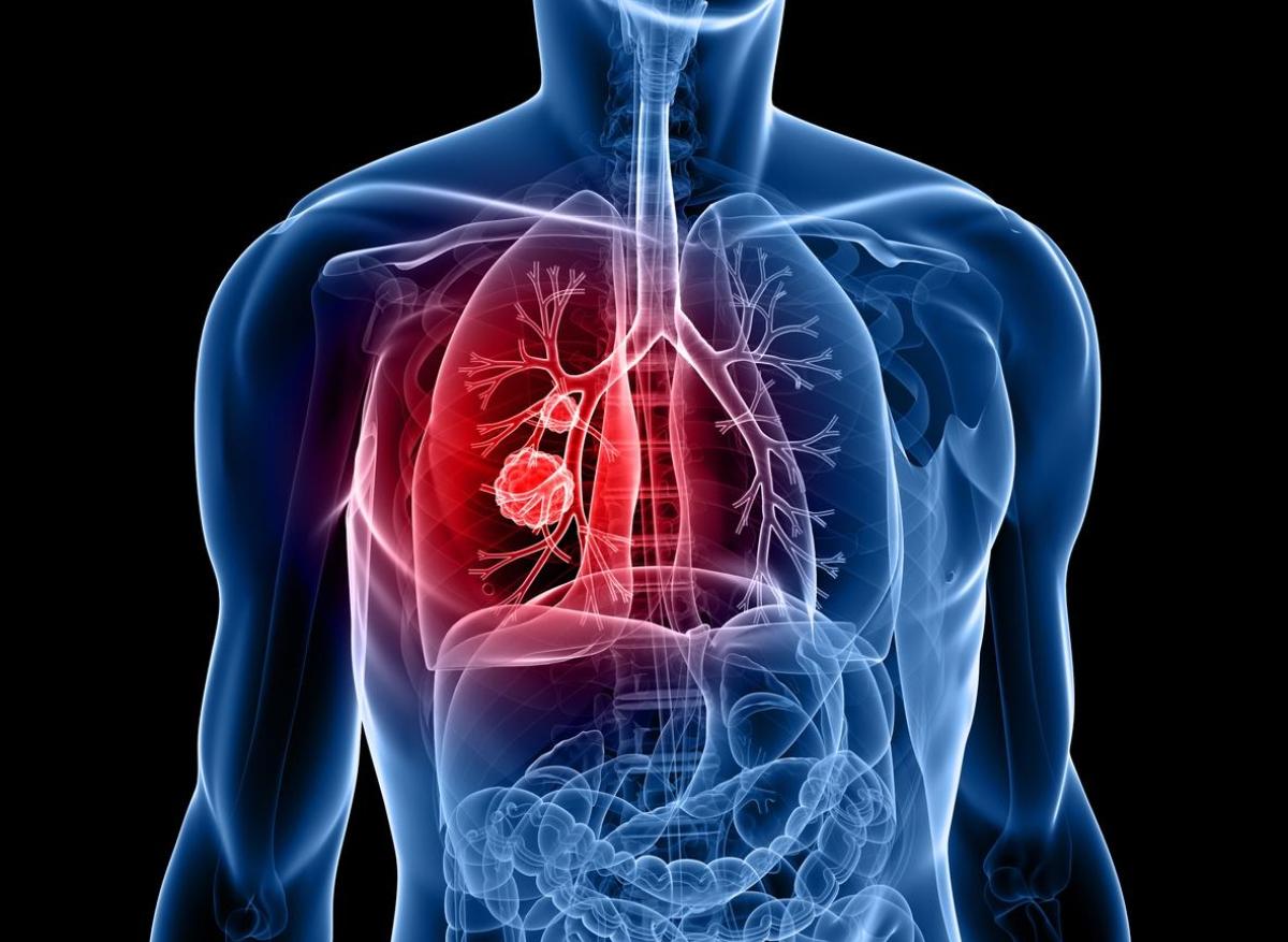 Tumeur du poumon : une technique d'ablation non-chirurgicale ...