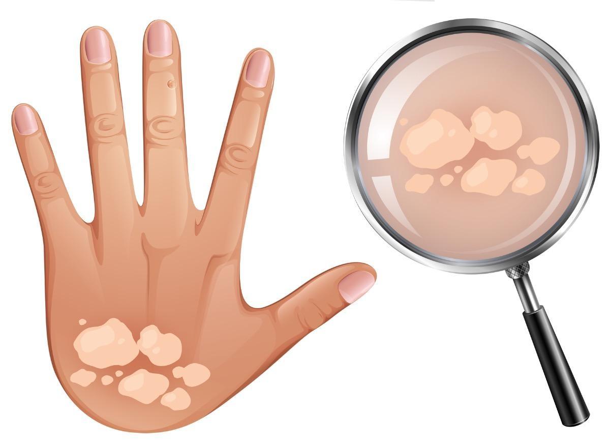 Soleil Attention Aux Champignons D Ete Soleil Attention Aux Champignons D Ete