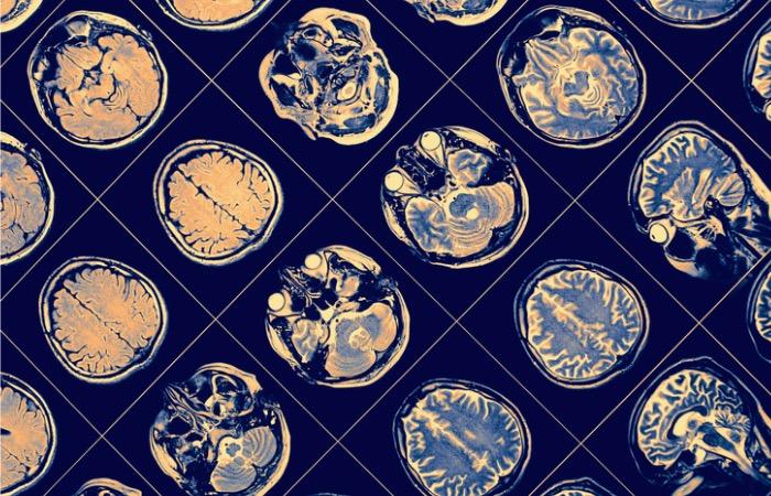 Schizophrénie : les patients auraient tous des fonctionnements cérébraux différents