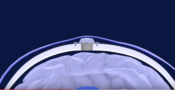 Tumeurs cérébrales : les ultrasons pourraient améliorer les traitements