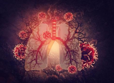 Cancer du poumon : ces signes doivent vous alerter