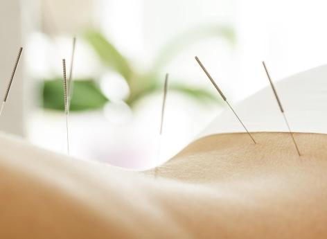 Polyarthrite rhumatoïde : l’acupuncture réduirait le risque accru d’AVC