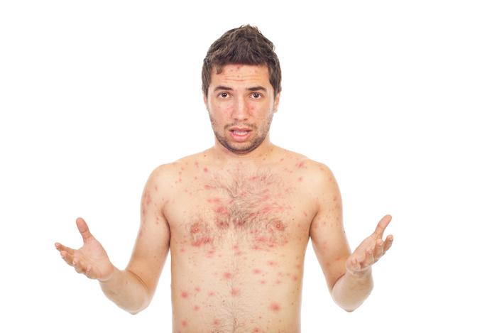 La varicelle est de retour : quels sont les risques pour les adultes non-immunisés ?