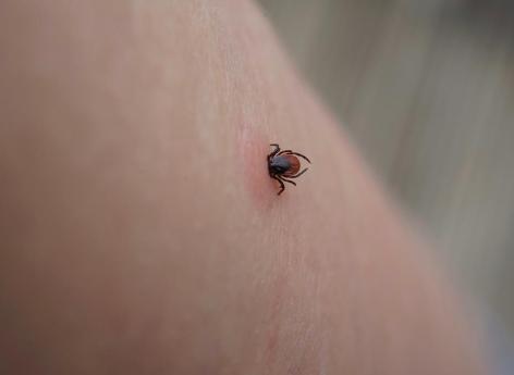 Maladie de Lyme : une prédisposition génétique en cause ?