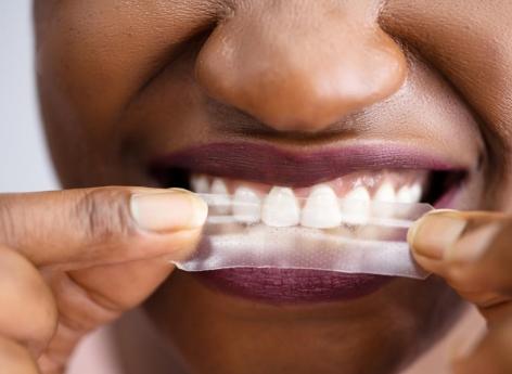 Blanchiment des dents : attention aux produits nocifs ou inutiles !