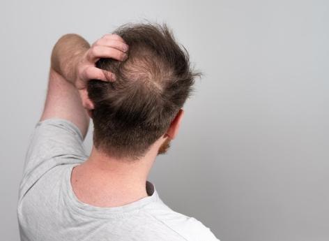 Perte de cheveux : et si une thérapie génique permettait de traiter l’alopécie ?