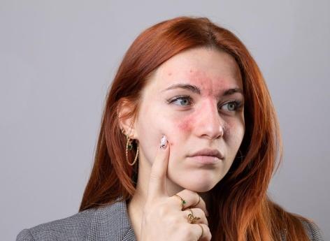Dermatite atopique ou eczéma : un Français sur deux est complexé par sa peau