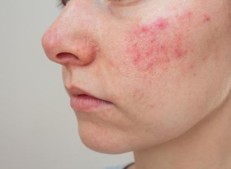 Rosacée : les conseils d’une dermato pour la réduire 