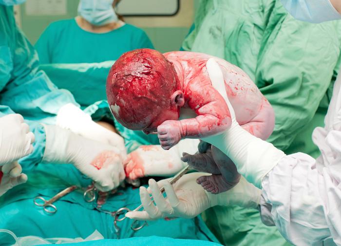 Césarienne: un coup de scalpel et 6 points de suture pour un nouveau-né 